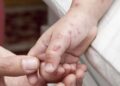 Penyakit Herpes Zoster: Dapat Terjadi Pada Orang Dewasa Berusia ≥50 tahun dan Kelompok Berisiko Lainnya di Provinsi Bali. -IST