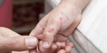 Penyakit Herpes Zoster: Dapat Terjadi Pada Orang Dewasa Berusia ≥50 tahun dan Kelompok Berisiko Lainnya di Provinsi Bali. -IST